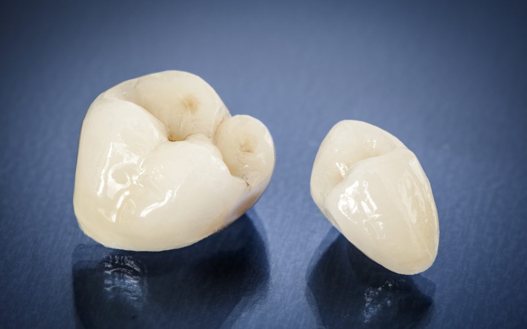 A Comprehensive Guide To Dental Crowns In San Francisco CA