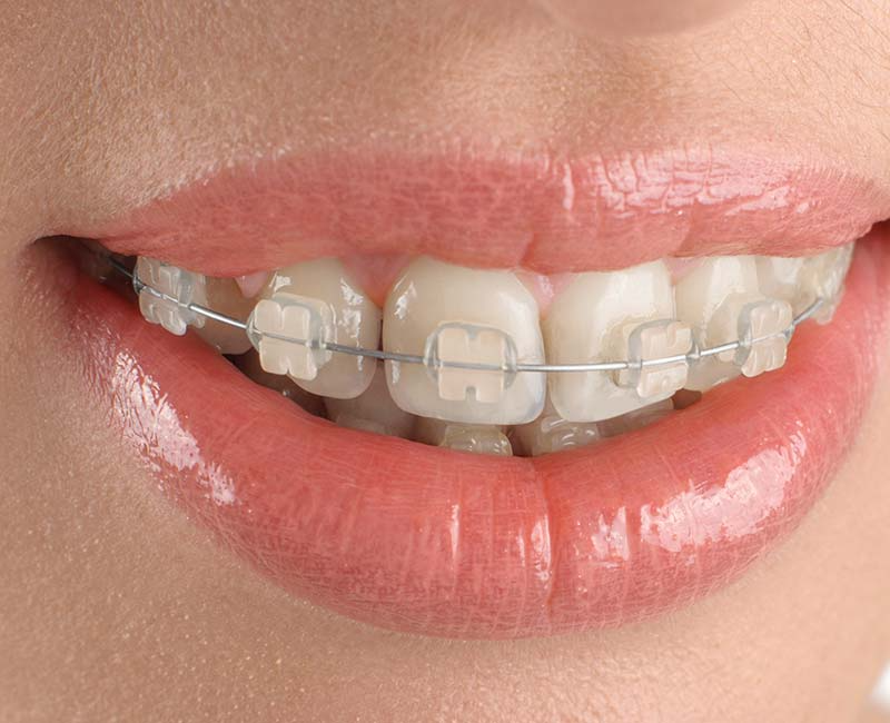 The Benefits Of Clear Braces In San Francisco For Adults And Teens